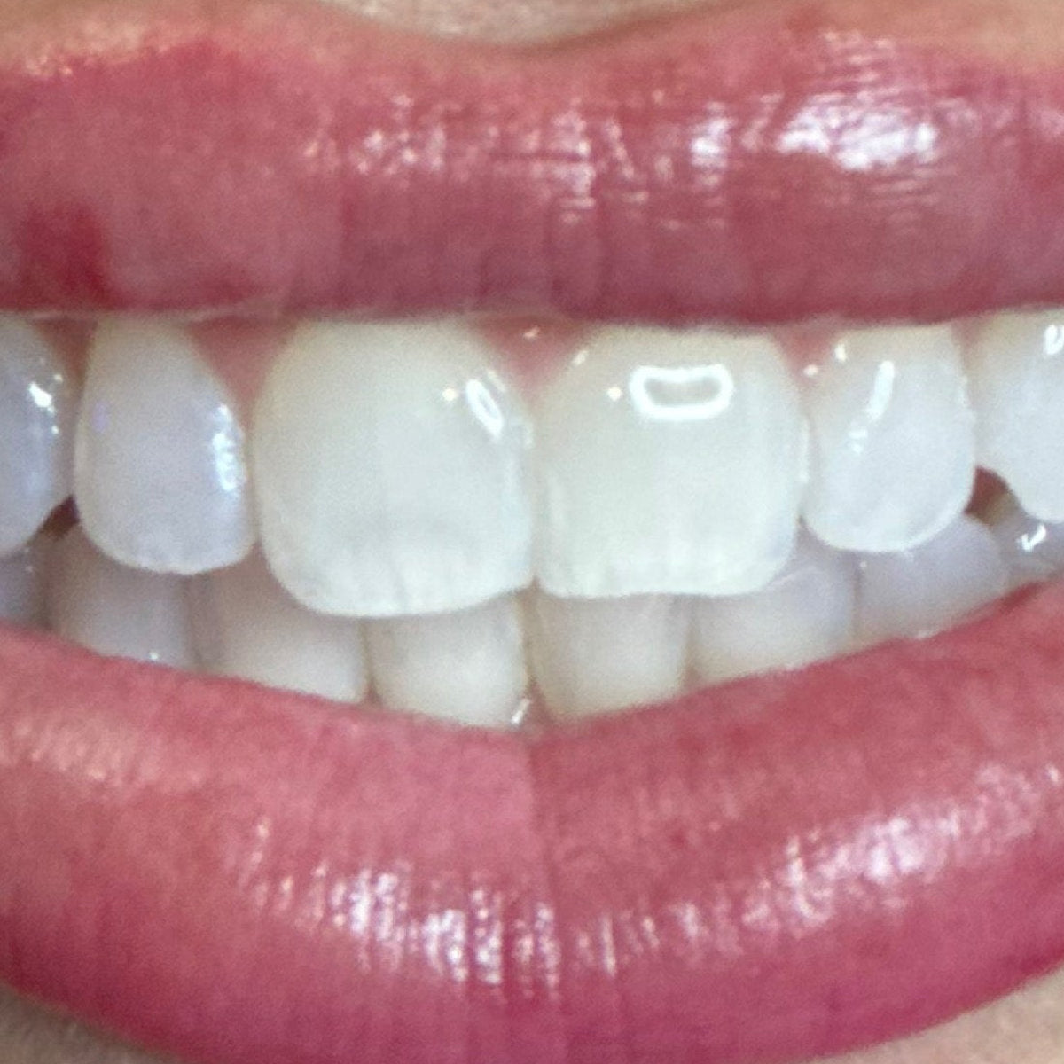 After whitening