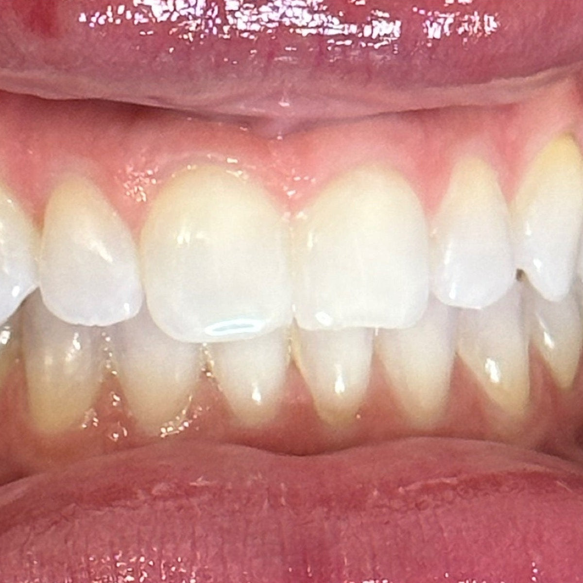 Before whitening