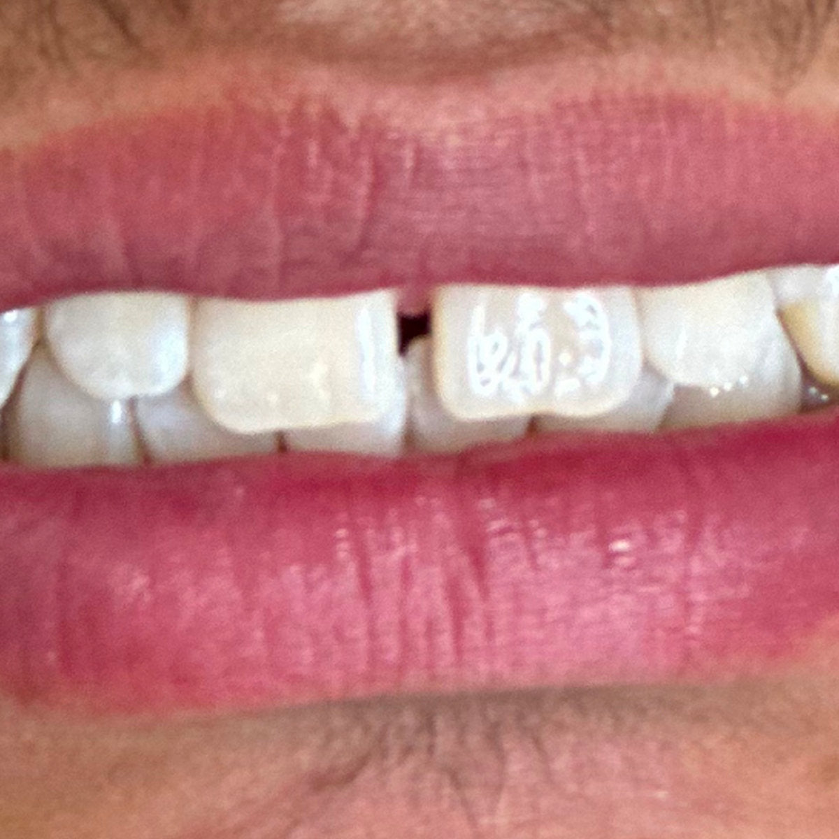 After whitening