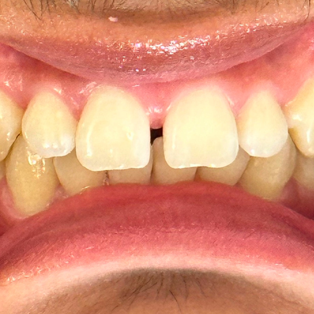 Before whitening