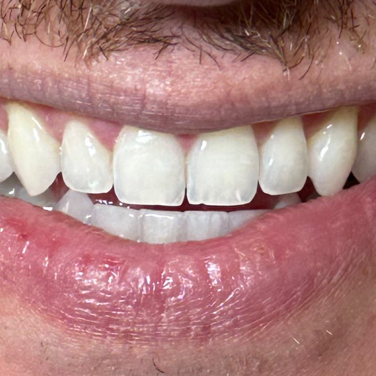 After whitening