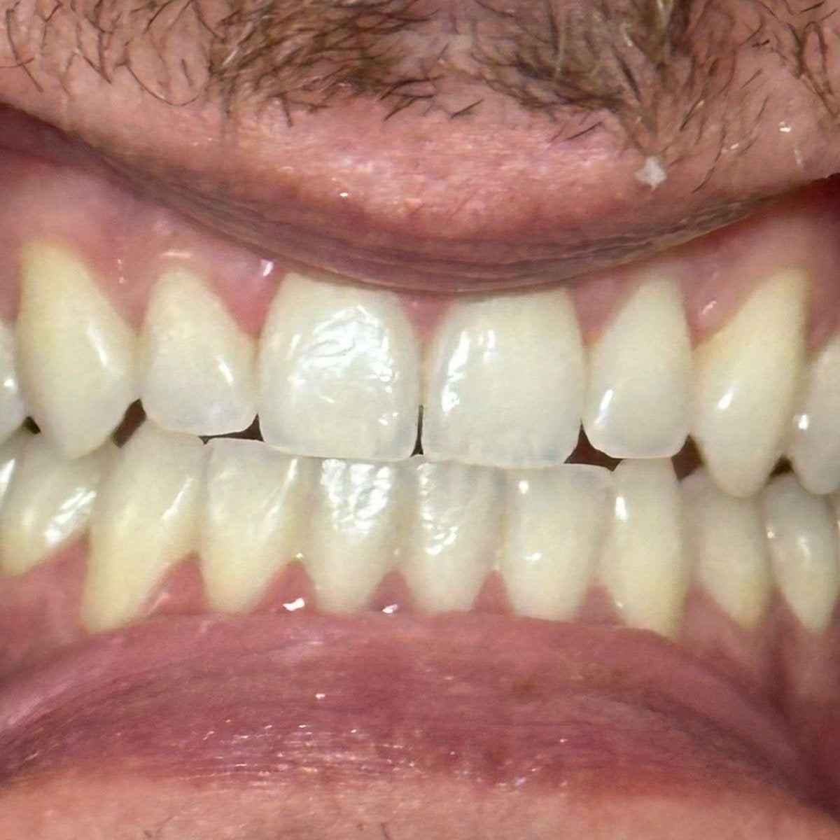 Before whitening