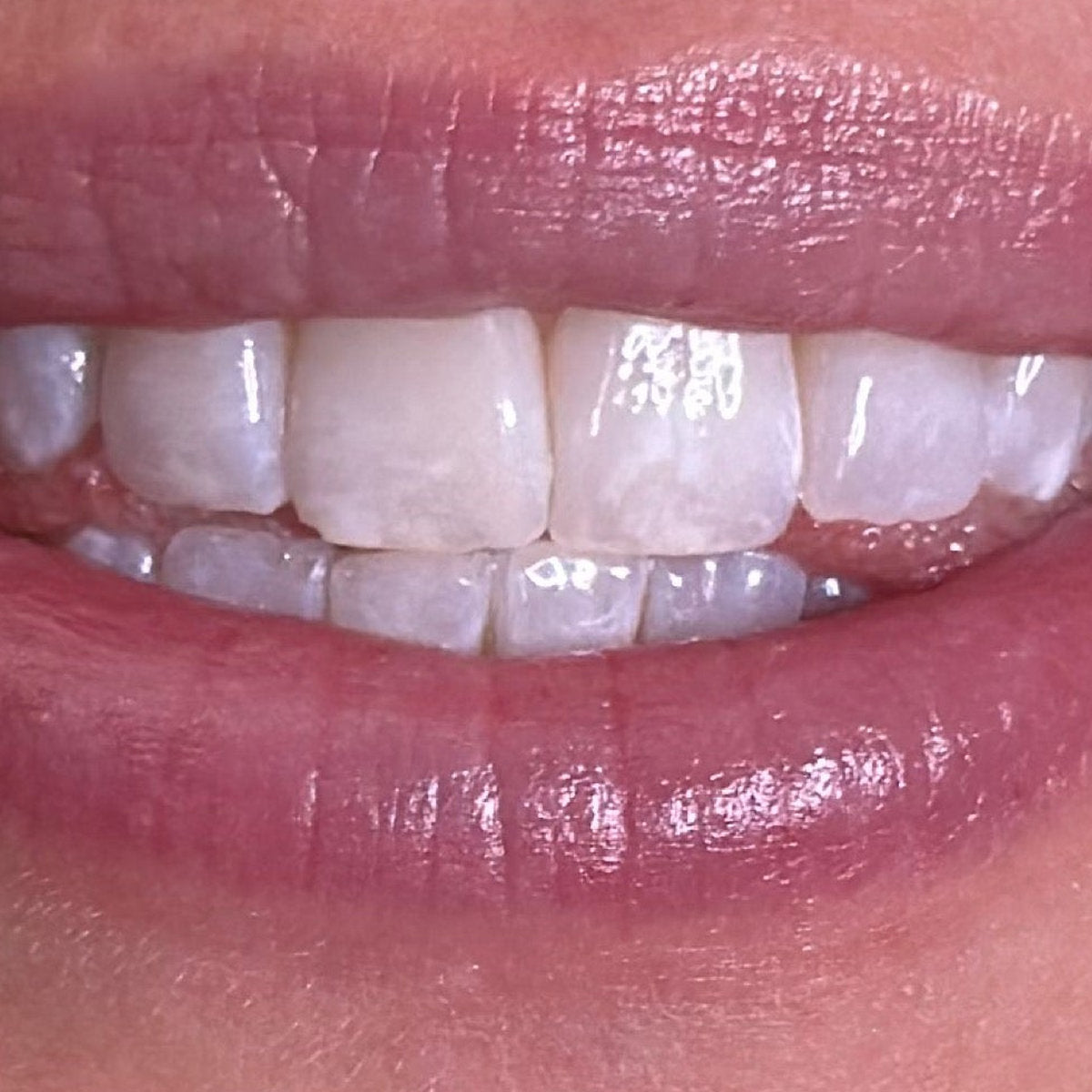 After whitening