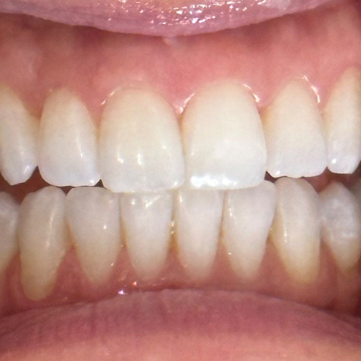 Before whitening